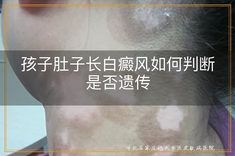 孩子肚子长白癜风如何判断是否遗传