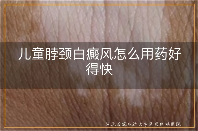 儿童脖颈白癜风怎么用药好得快