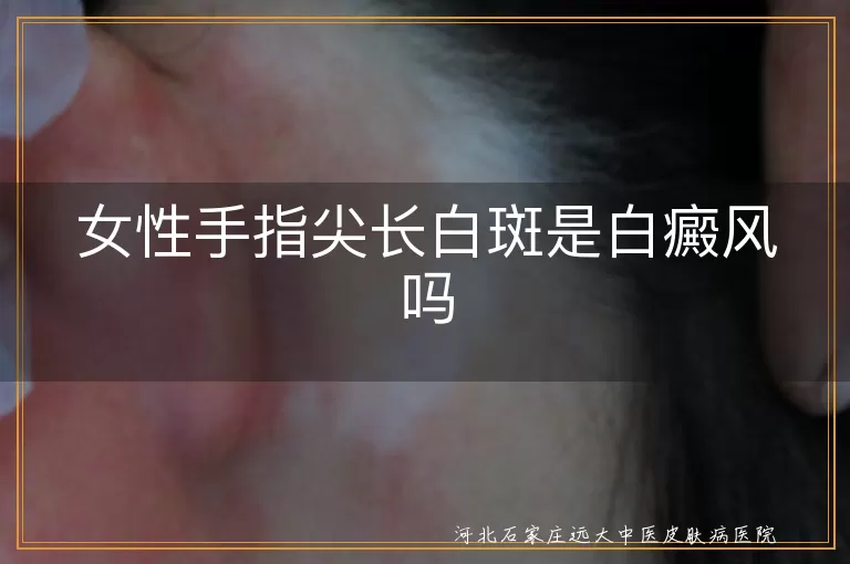 女性手指尖长白斑是什么,手指尖出现白癜风怎么回事,女人指尖长白斑是白癜风吗