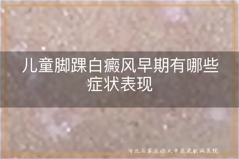 儿童脚踝白癜风早期症状有哪些,孩子脚踝白斑初期表现是什么,脚踝白癜风儿童早期识别方法