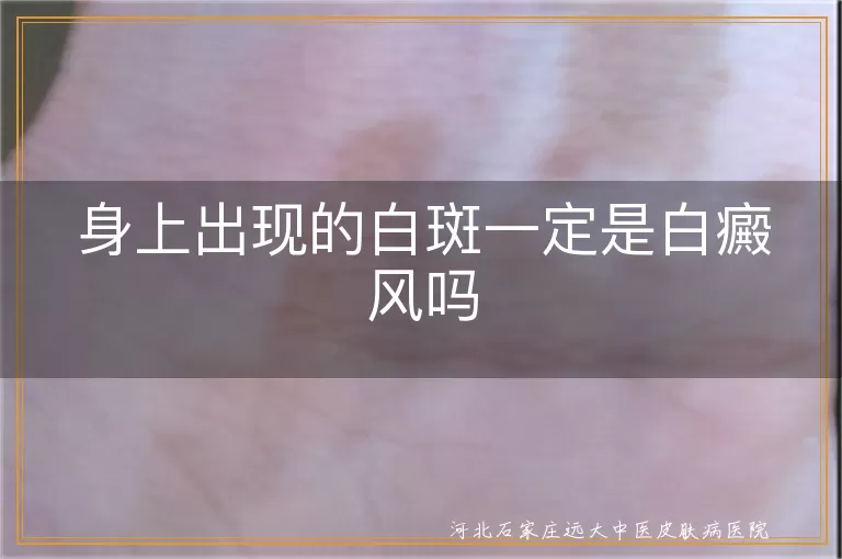 身上出现的白斑一定是白癜风吗