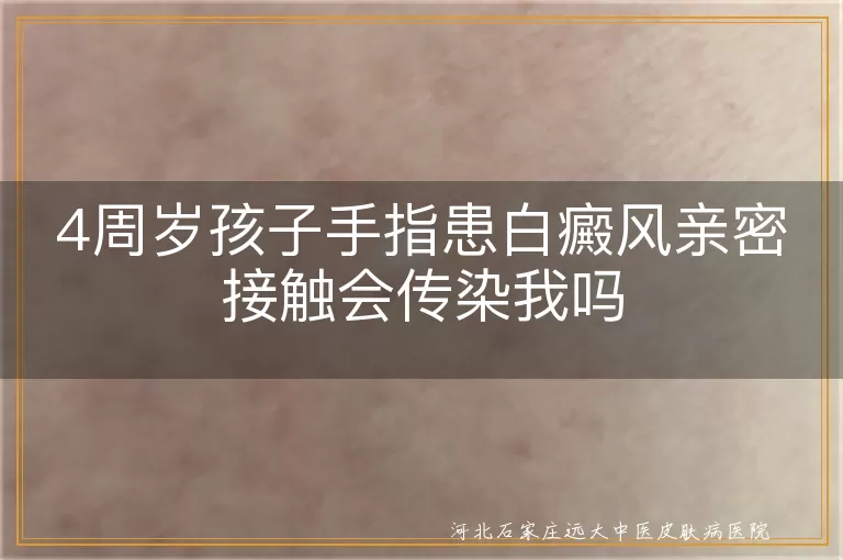 4周岁孩子手指患白癜风亲密接触会传染我吗