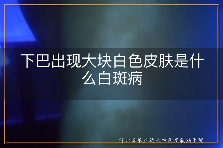 下巴大块白色皮肤是白癜风吗,下巴出现白斑是哪种皮肤病,下巴白色斑块是不是白癜风