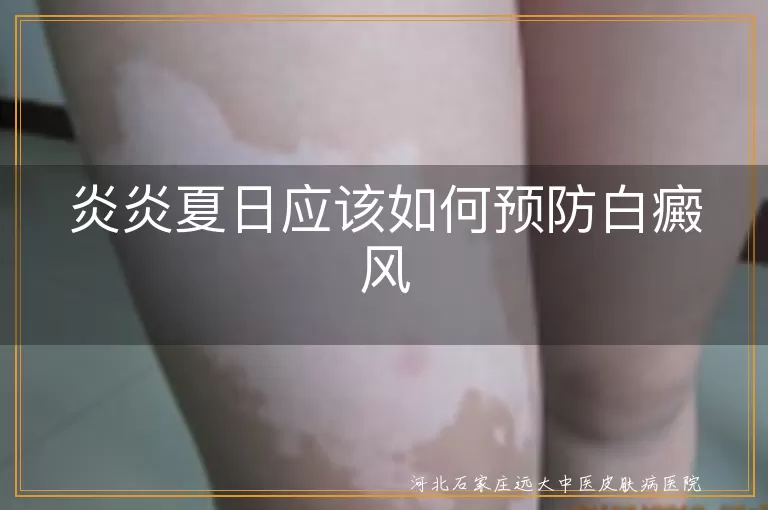 夏天怎么预防白癜风发生,夏季白癜风预防方法分享,炎炎夏日怎样远离白癜风