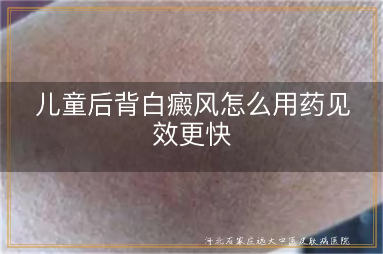 儿童后背白癜风怎么用药好得快,孩子背部白斑怎样治疗见效快,儿童后背有白癜风如何用药恢复