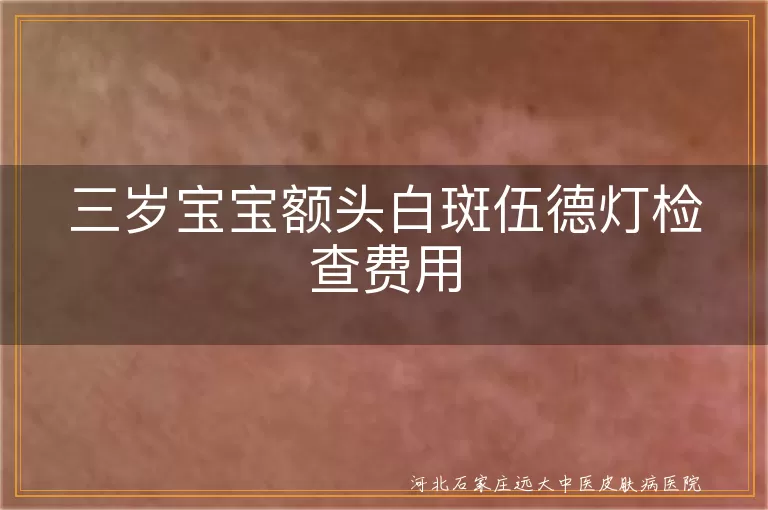 三岁宝宝额头白斑伍德灯检查费用