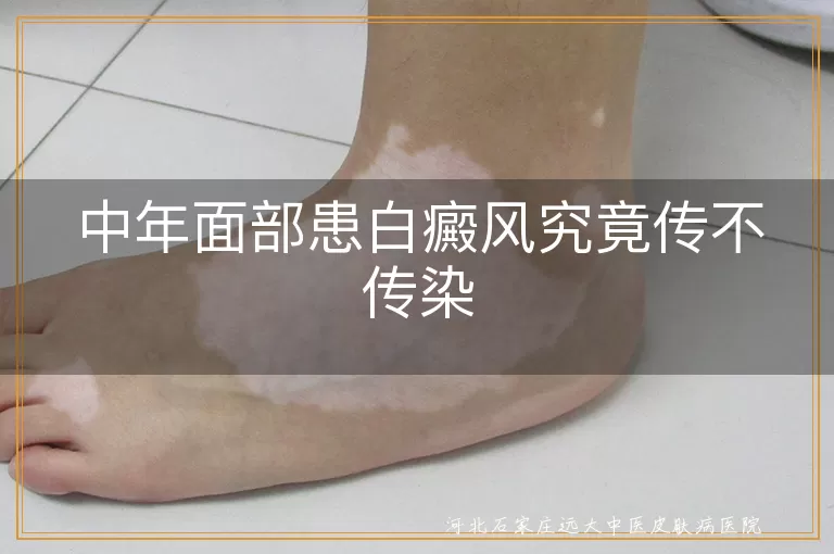 中年面部白癜风会传染别人吗,脸上长白斑病传染家人吗,中年人患白癜风传染问题解答