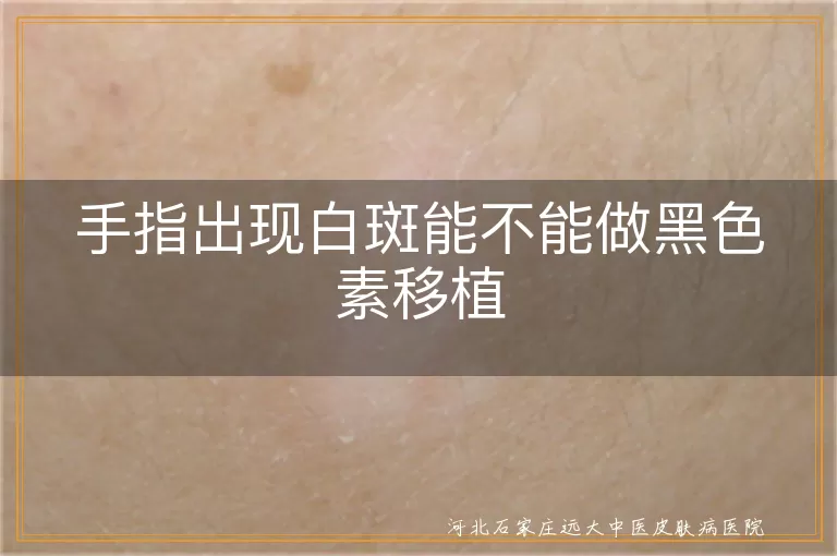 手指白癜风能做黑色素移植吗,手部白斑种植黑色素效果,手指白斑黑色素种植条件