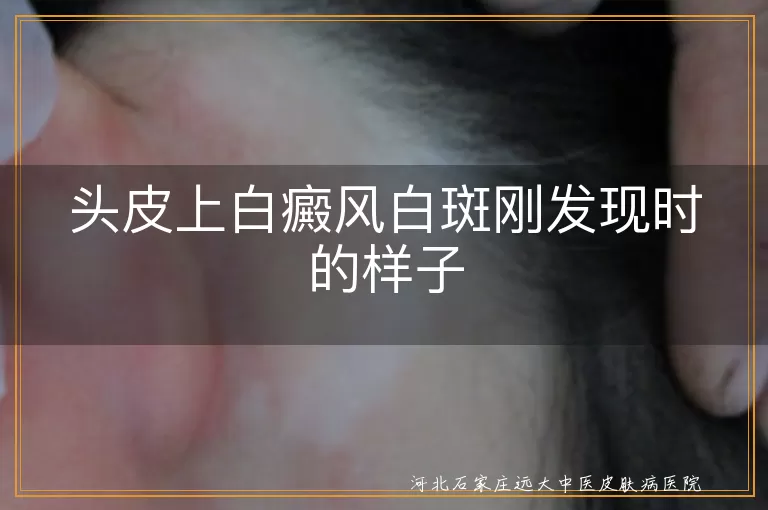 头皮白癜风早期白斑什么样,头上白斑刚发现时的症状,头皮白斑初期表现有哪些