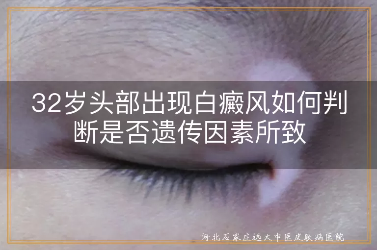 头部白斑是不是遗传来的怎么查,三十二岁头皮白癜风遗传判断法,成人头部白斑遗传因素确认方法