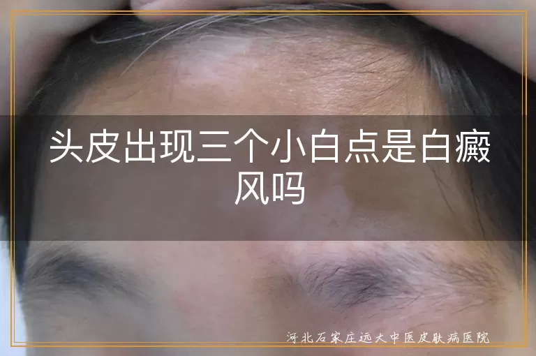 头皮三个小白点是不是白癜风,头皮出现白点是白癜风吗,头皮长白斑究竟怎么回事
