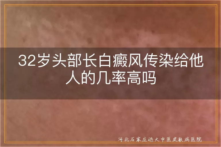 头部白癜风传染几率有多高,三十二岁长白癜风会传染吗,白斑皮肤病会不会传染别人