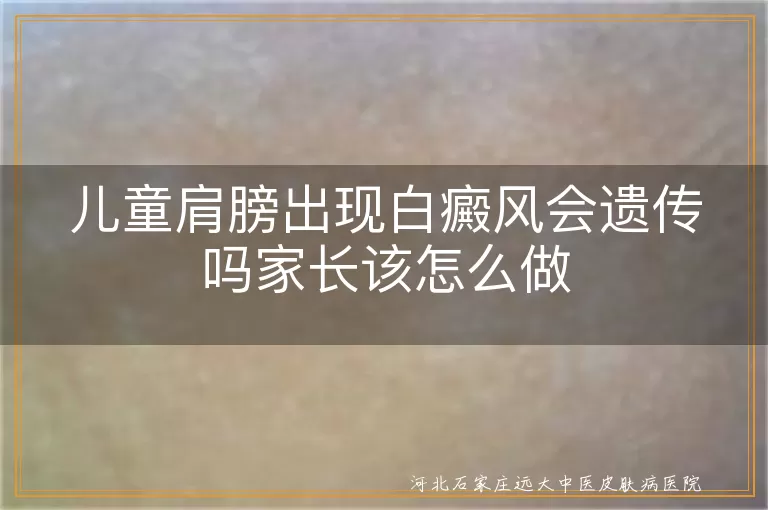 儿童肩膀白癜风遗传概率大吗,孩子肩膀白斑是不是会遗传,儿童白癜风遗传因素怎么办