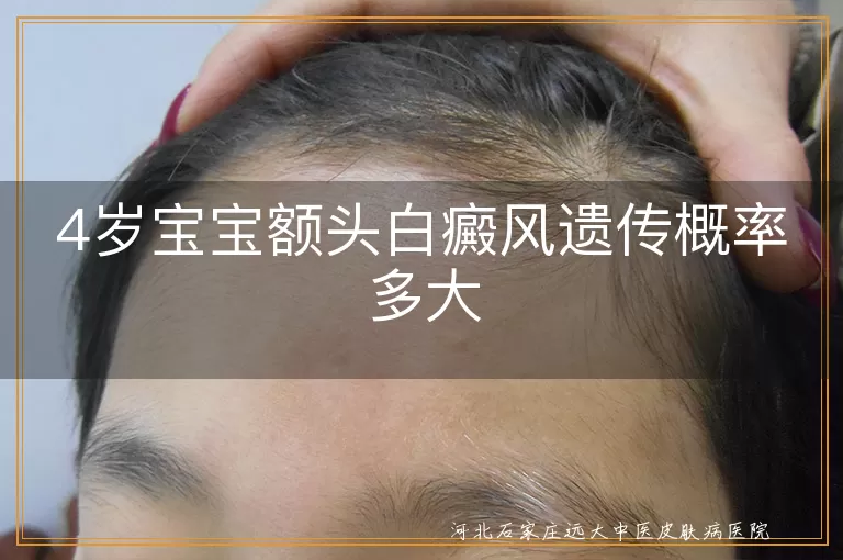 宝宝额头白癜风遗传概率多大,四岁孩子得白癜风遗传几率,儿童额头白斑遗传可能性