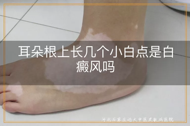 耳朵根长小白点是白癜风吗,耳后出现白斑是不是白癜风,耳根长白点可能是白癜风吗