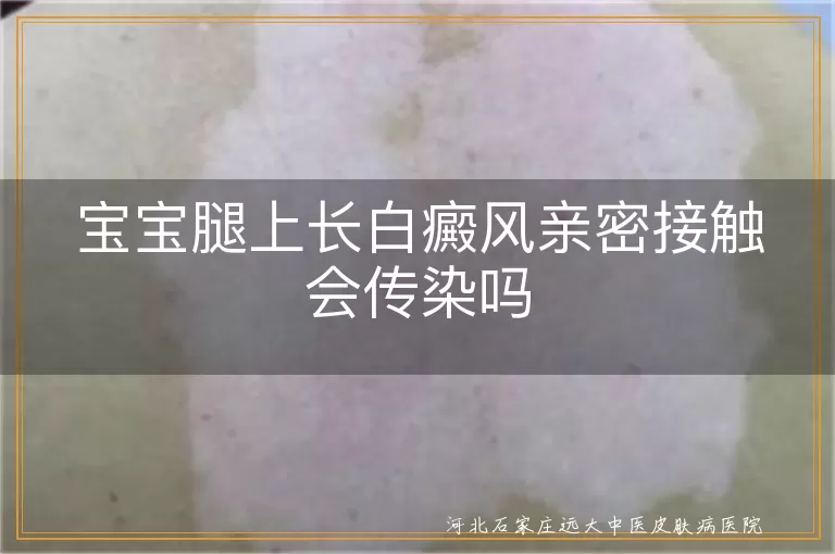 婴幼儿白癜风亲密接触会不会传染,宝宝腿上有白癜风接触传染吗,婴儿白癜风近距离接触传染吗