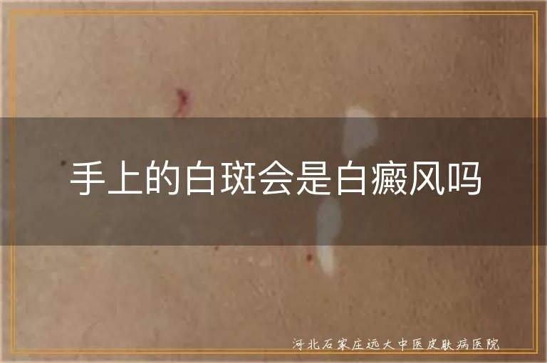 手上长白斑是白癜风吗,手部白斑是不是白癜风,手上出现白斑什么病