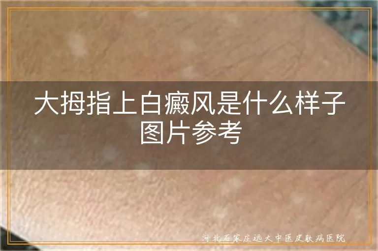 大拇指上白癜风症状图片展示,手指白斑是什么样子照片,拇指白癜风早期症状图片