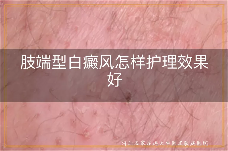 肢端型白癜风怎样护理好,手足白癜风日常护理方法,白斑患处皮肤护理要点