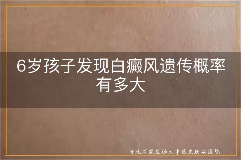 6岁孩子发现白癜风遗传概率有多大