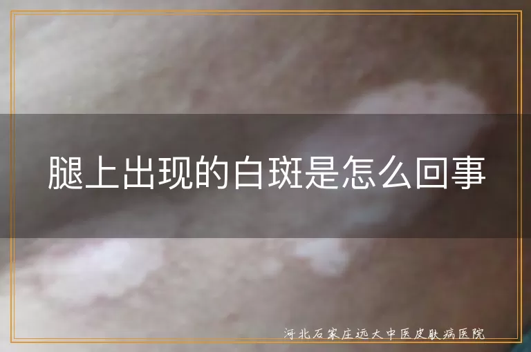 腿上出现的白斑是怎么回事