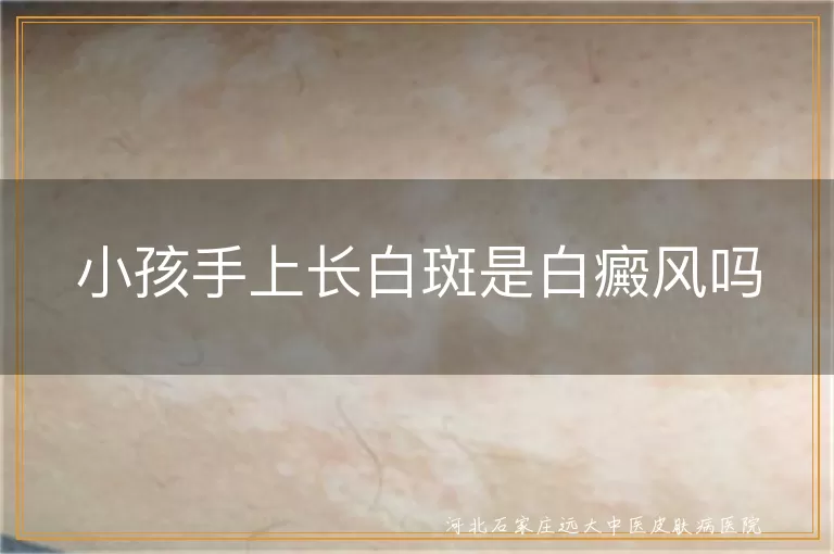小孩手上长白斑是白癜风吗