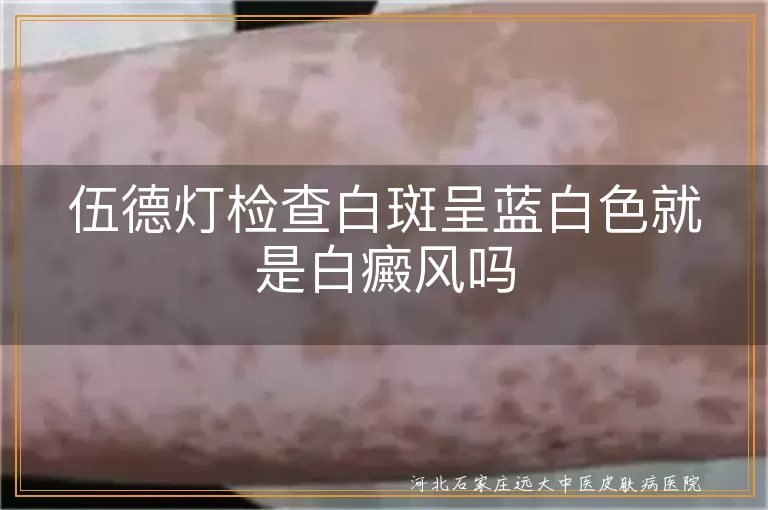 伍德灯检查白斑呈蓝白色就是白癜风吗