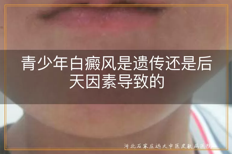 青少年白癜风是遗传还是后天因素导致的