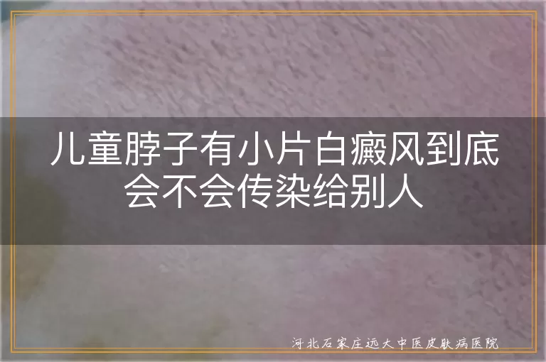 儿童脖子有小片白癜风到底会不会传染给别人