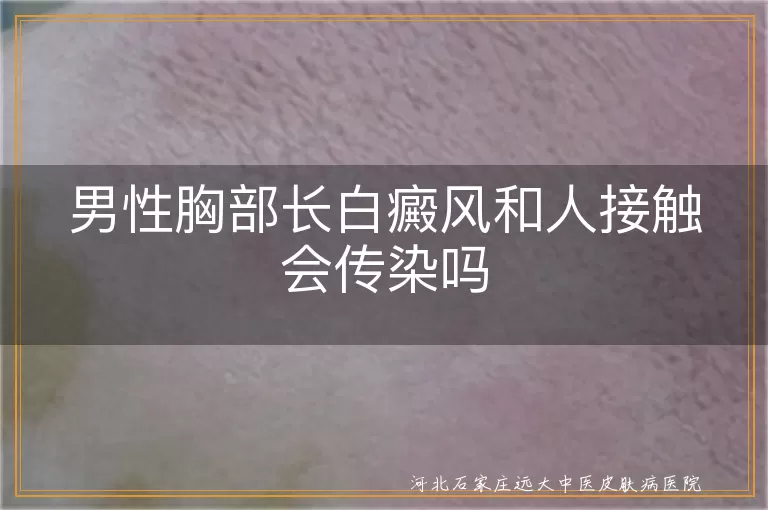 男性胸部白癜风会传染吗,胸口长白斑接触传染吗,白癜风通过接触传播吗