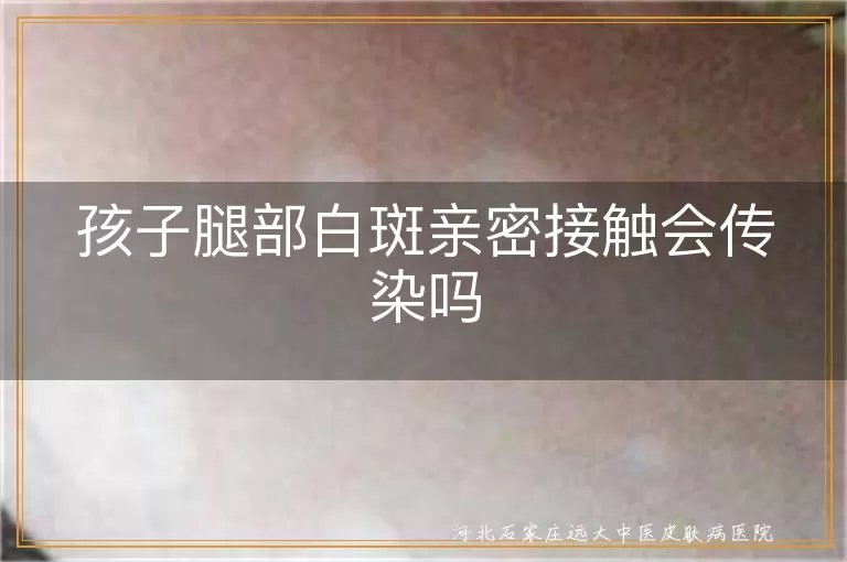 儿童腿上患白癜风接触传染吗,孩子腿部长白斑亲密接触传染吗,腿部白癜风亲密接触会传染吗