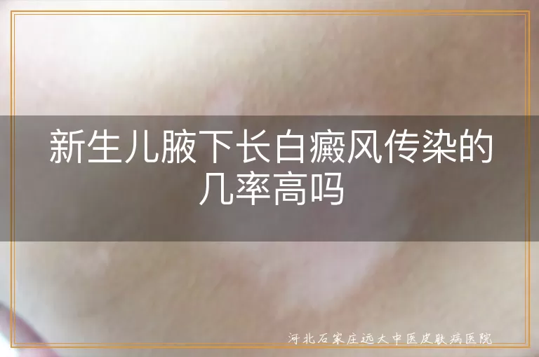 新生儿腋下长白癜风传染的几率高吗