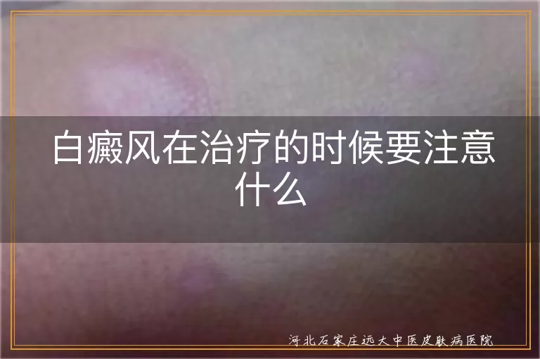 白癜风在治疗的时候要注意什么