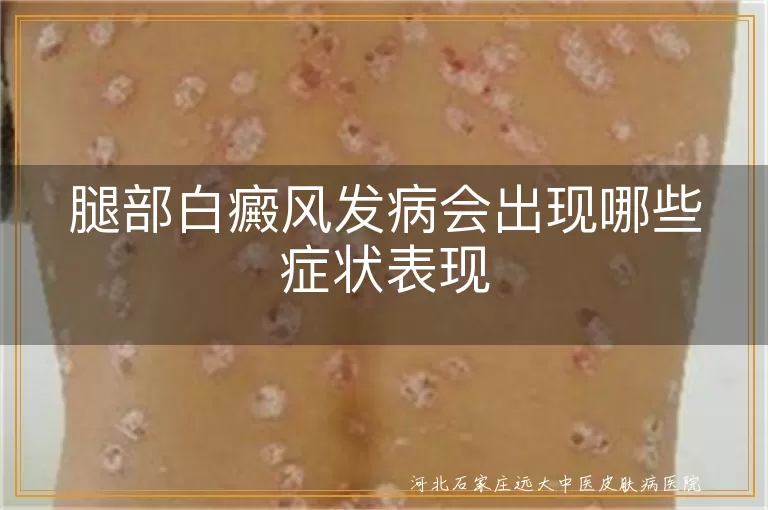 腿部白斑初期症状表现,腿上白癜风有什么症状,腿部皮肤白斑发病特征