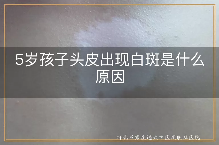 5岁头皮长白斑怎么回事,5岁儿童头部长白癜风原因,孩子头上长白点点是白癜风吗