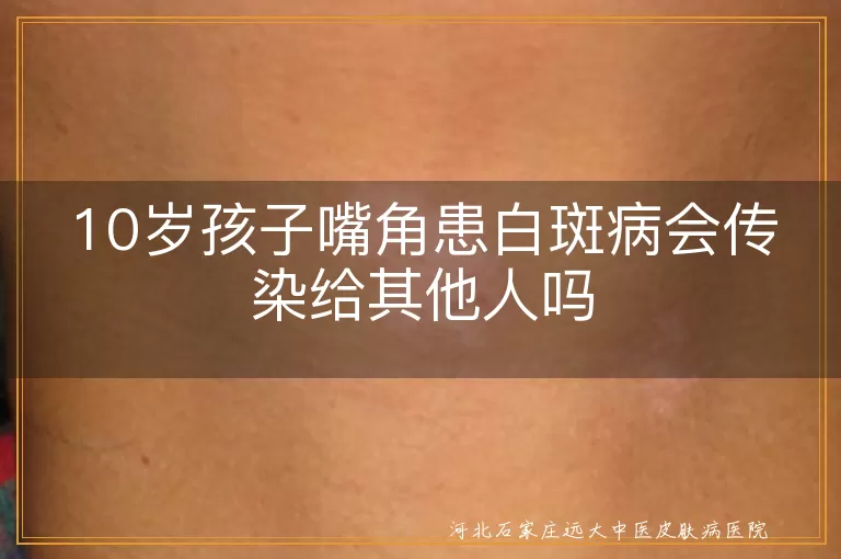 儿童嘴角白癜风会不会传染他人,十岁孩子长白斑病会传染吗,小孩嘴角出现白斑传染吗