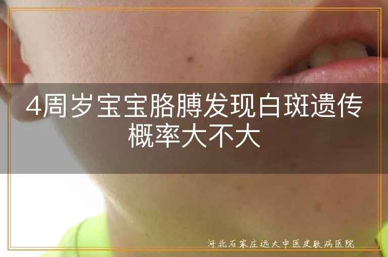 4周岁宝宝胳膊发现白斑遗传概率大不大