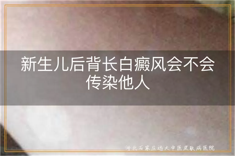 新生儿后背长白癜风会不会传染他人
