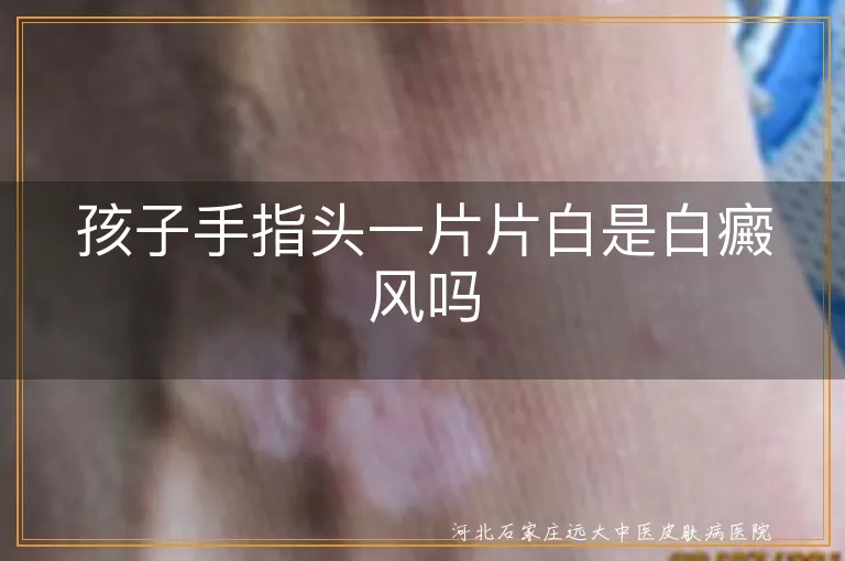 孩子手指头一片片白是白癜风吗