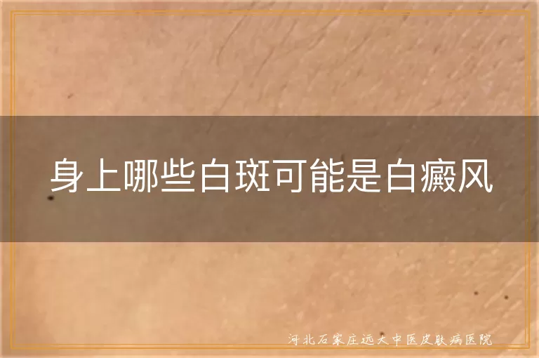 身上哪些白斑可能是白癜风