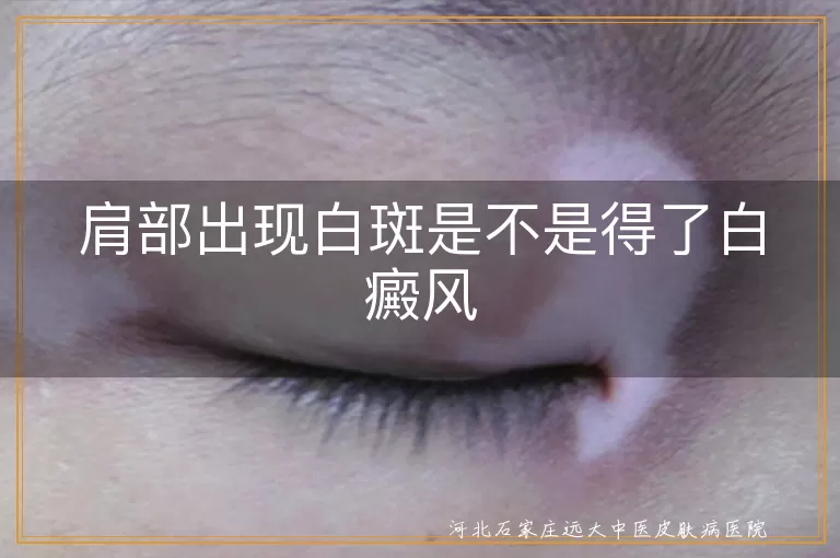 肩膀有白斑是白癜风吗,肩部白斑是不是白癜风,肩膀长白斑会是白癜风吗