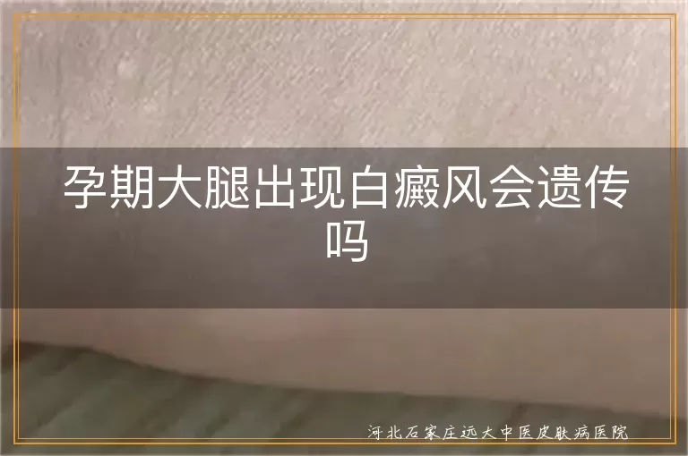 孕期大腿白癜风会遗传吗,孕妇大腿白斑是不是遗传,怀孕时长白癜风如何判断遗传