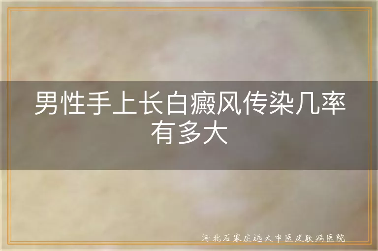 男性手部白癜风传染几率有多大,手上长白斑会不会传染给别人,男性白癜风传染风险高不高