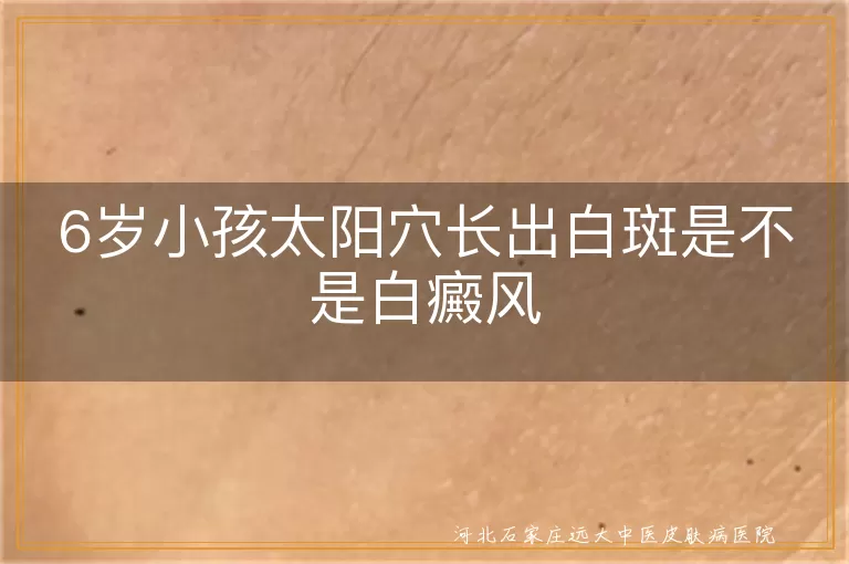 6岁孩子太阳穴白斑是白癜风吗,儿童太阳穴白斑怎么回事,小孩太阳穴长白斑是不是白癜风