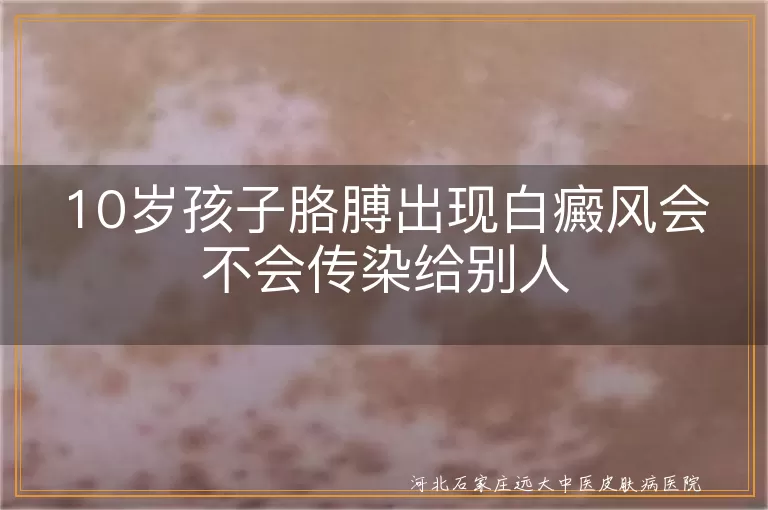 10岁孩子胳膊出现白癜风会不会传染给别人