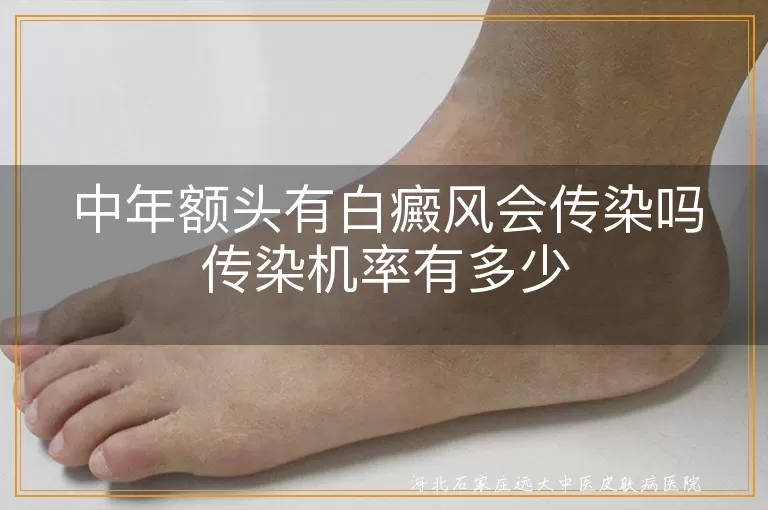 中年额头有白癜风会传染吗传染机率有多少