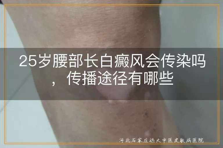 25岁腰部长白癜风会传染吗，传播途径有哪些
