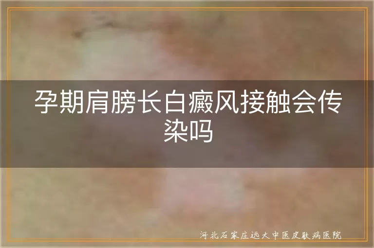 孕期肩膀长白癜风会传染吗,怀孕时长白斑跟人接触传染吗,孕妇肩部白癜风传染家人吗