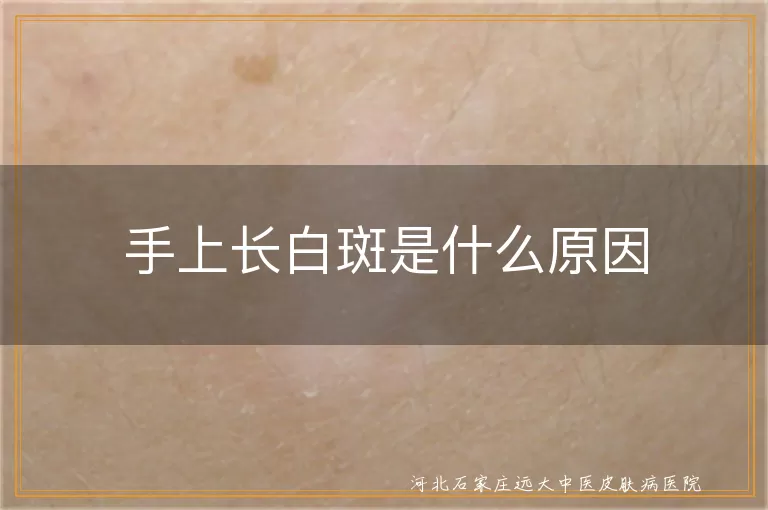 手上出现白斑是什么原因,手部白癜风发病原因有哪些,手指长有白斑怎么回事