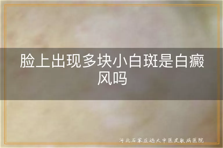 脸上出现多块小白斑是白癜风吗